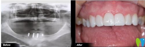 68歲叔叔在歡樂仁愛口腔做完種植牙前后對比照