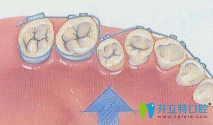 牙齒矯正示意圖