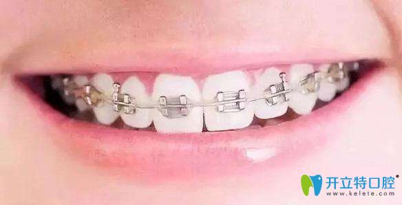 瑞德口腔傳統(tǒng)金屬托槽矯正器