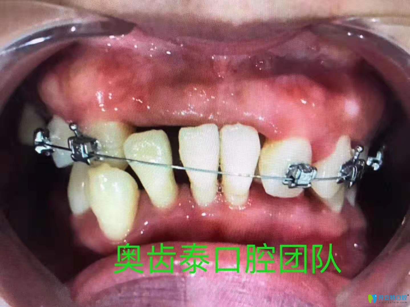 牙周炎都這樣了,金屬自鎖托槽矯正半年后這效果必須點(diǎn)贊