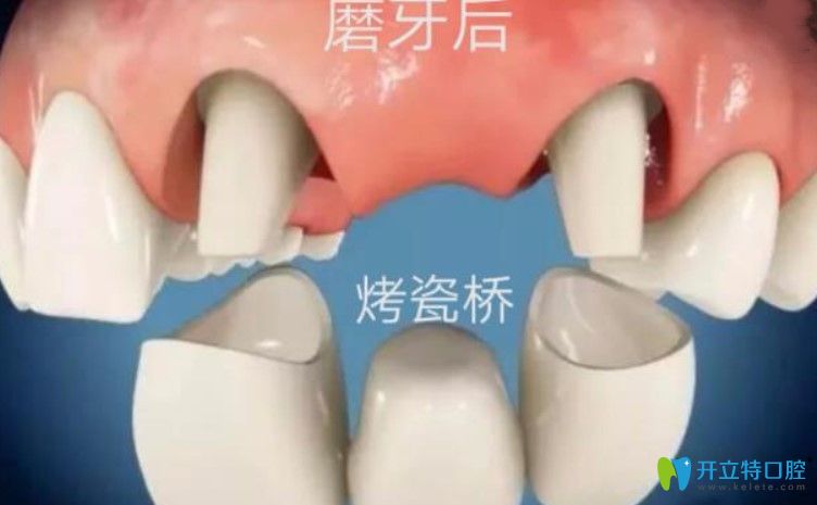 剛戴上全瓷牙咬東西疼是咋回事？趕緊戳進來看看吧