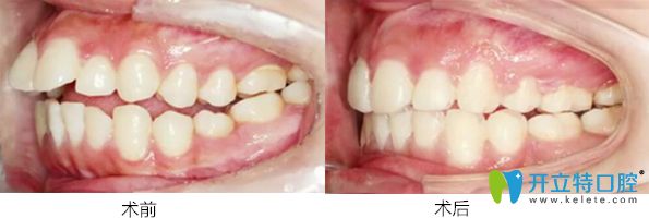 珠海愛(ài)思特口腔 齙牙矯正案例
