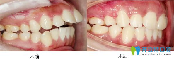 珠海愛(ài)思特口腔隱適美矯正案例