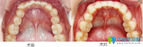 珠海愛(ài)思特口腔醫(yī)院開(kāi)頜隱適美矯正