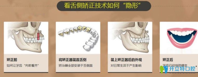 舌側(cè)隱形牙齒矯正的價格