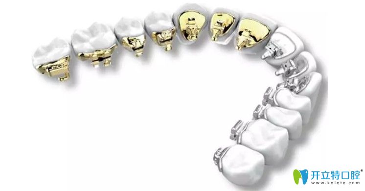 帶你走出長沙舌側(cè)隱形牙齒矯正價(jià)格的誤區(qū)