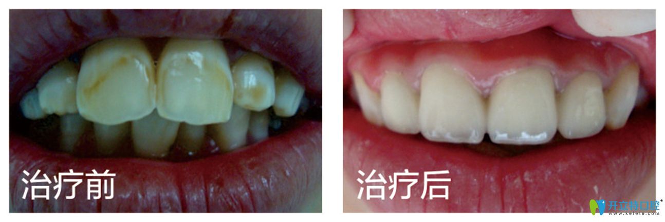 黃牙妹子看過氟斑牙做完皓齒美白的前后對比照,你不心動嗎