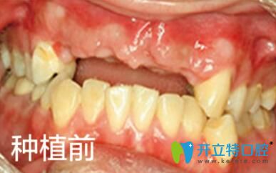 缺失4顆門牙的照片