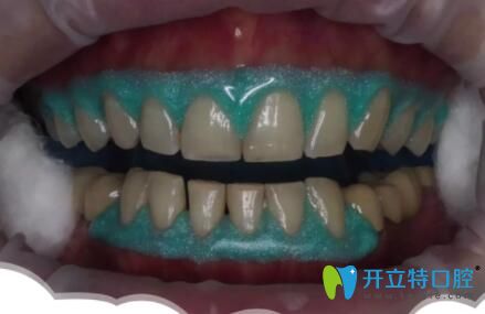 皓齒美白牙齦保護(hù)劑