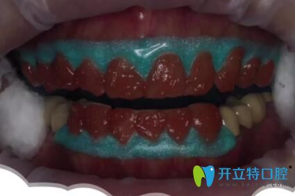 皓齒美白過(guò)程
