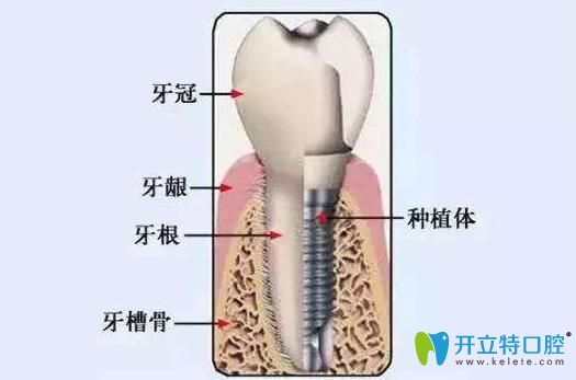 種牙熱點報道:種植牙和植骨手術(shù)可以同時進行嗎?