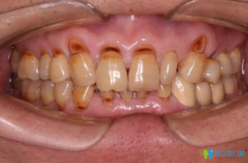 深圳這家牙科的醫(yī)生對(duì)牙楔狀缺損顧客做了什么竟被送錦旗