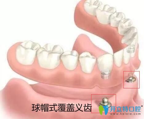 價(jià)格吊打種植牙的全口覆蓋義齒修復(fù)到底有哪些優(yōu)缺點(diǎn)？