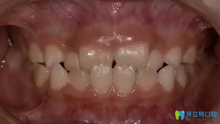 兒童反頜就是地包天需要做正畸