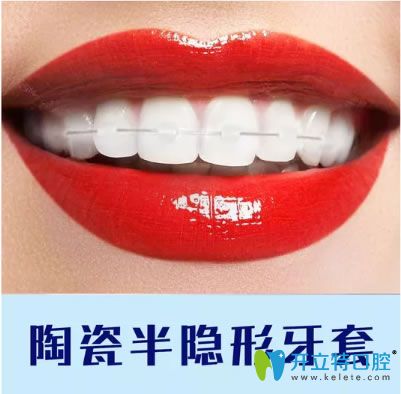 重慶維樂口腔陶瓷半隱形牙套