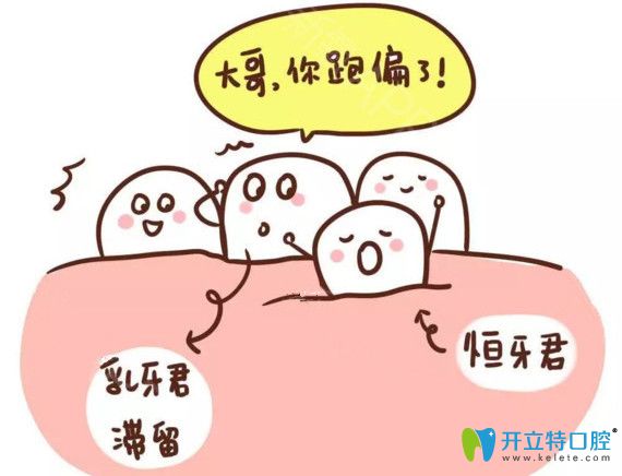 乳牙滯留恒牙萌出會導(dǎo)致牙列不齊的情況出現(xiàn)