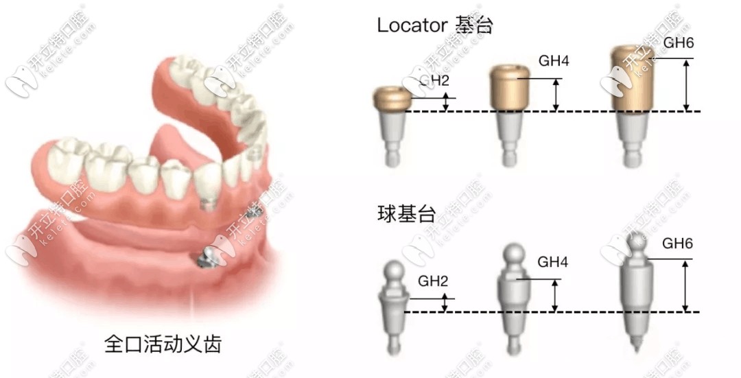 locator基臺和球帽基臺區(qū)別圖