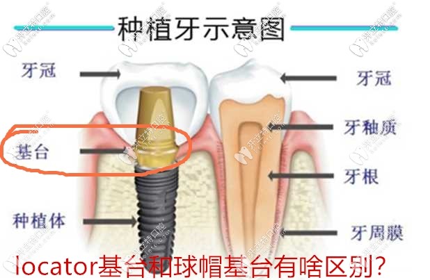 看這簡單的幾張圖就能明白locator基臺和球帽基臺的區(qū)別