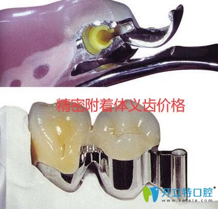 精密附著體義齒價(jià)格