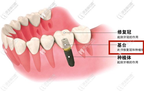 種植牙基臺部位