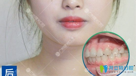 齙牙做完時代天使矯正后的樣子 齙牙做完時代天使矯正后的樣子