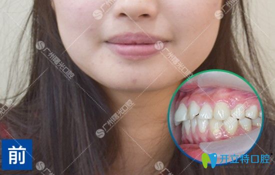沒做矯正之前的牙齒情況 沒做矯正之前的牙齒情況