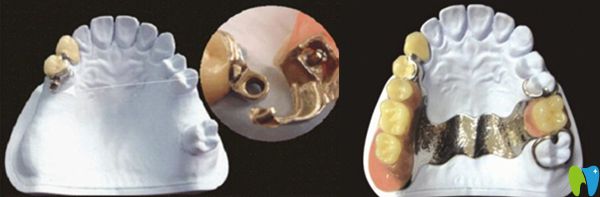 栓道式精密附著體