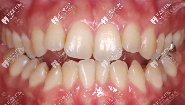 牙齒開頜沒做矯正之前的照片