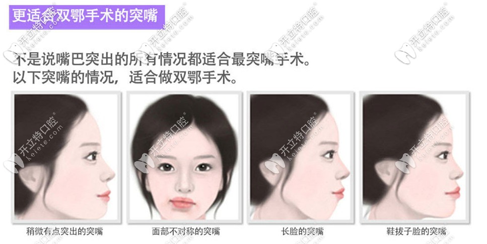 Faceline適合做雙鄂手術(shù)的凸嘴 Faceline適合做雙鄂手術(shù)的凸嘴