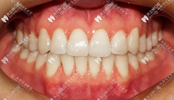 牙齒開頜矯正后效果圖