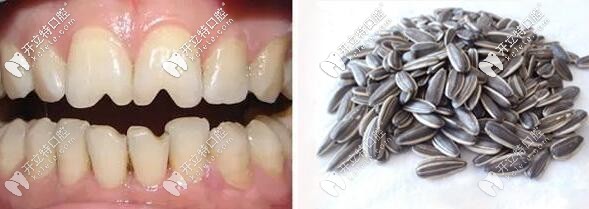 瓜子牙修復(fù)的方式有哪幾種