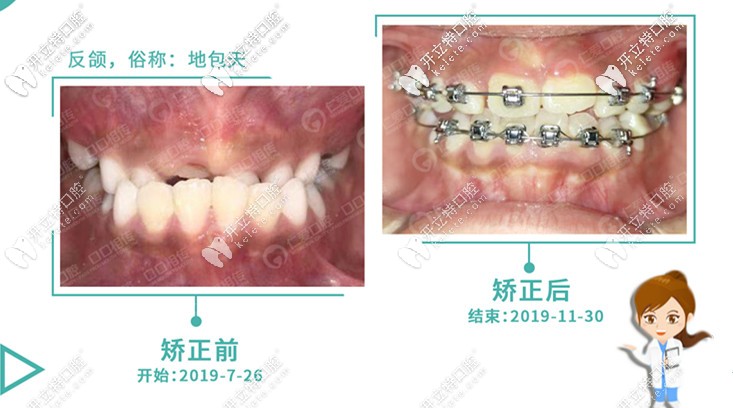 記錄8歲兒童牙性地包天戴mrc矯正器+國產(chǎn)金屬自鎖牙套的經(jīng)歷