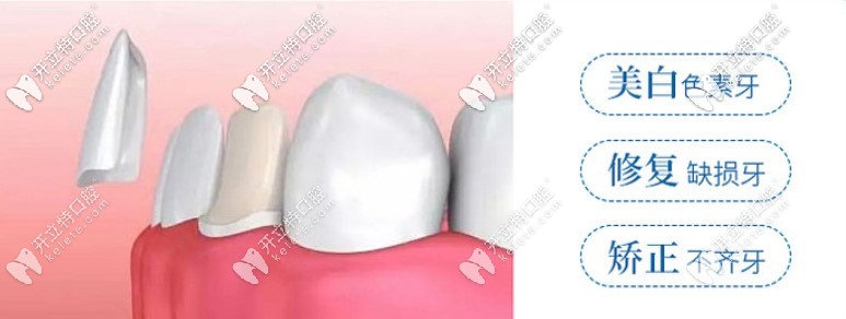 牙縫太大可以通過(guò)牙齒貼片改善