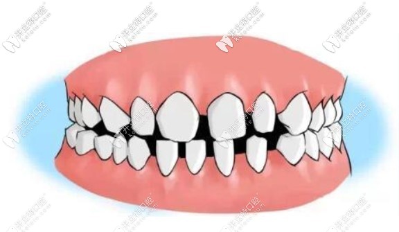 我的牙縫很大，到底需不需要補(bǔ)呀