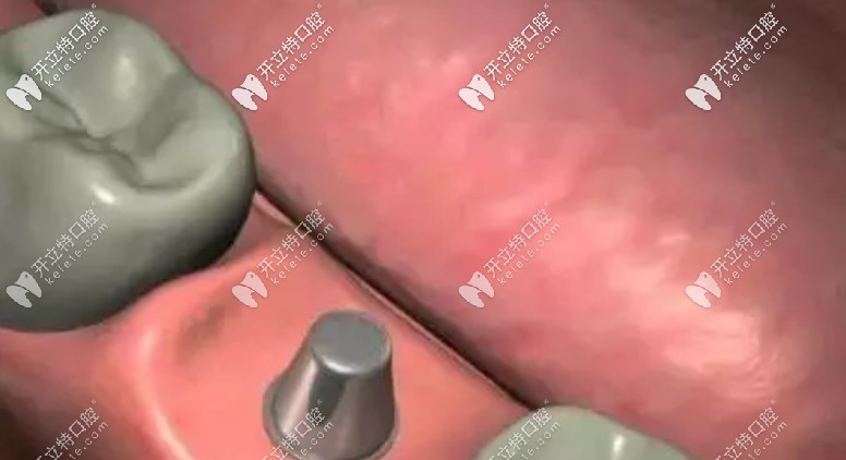 將愈合基臺(tái)換成正式基臺(tái)