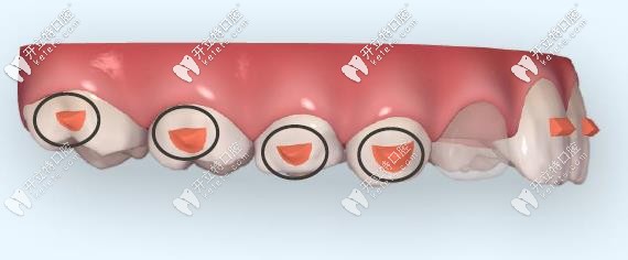 Invisalign first兒童矯正技術(shù)