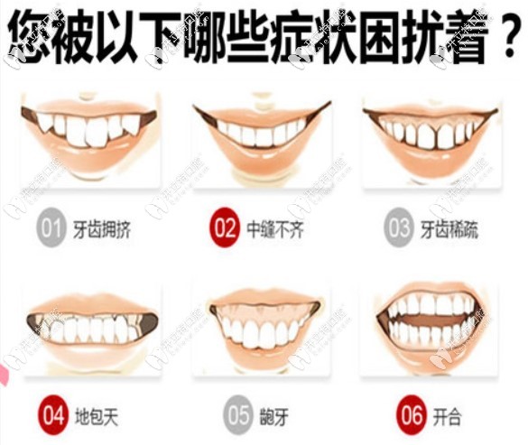 圖示牙齒情況都可以通過gac托槽矯正