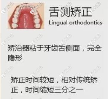 舌側(cè)矯正優(yōu)點