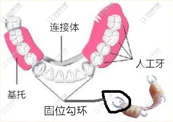 隱形義齒雖然也是活動義齒但是區(qū)別還是有點大