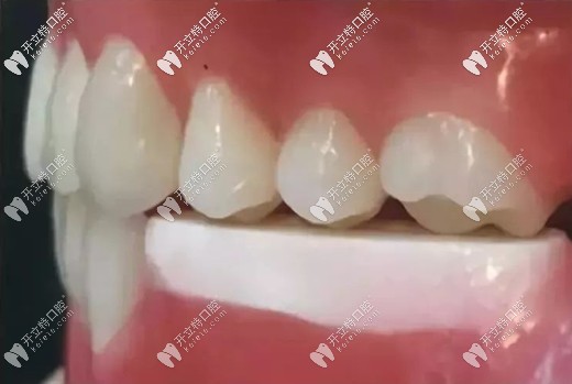 戴臨時(shí)義齒還可防止植體周圍菌斑附著