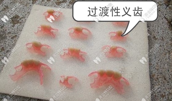 誰知道種植牙的過渡義齒能用多久呢?若長期佩戴可以嗎？