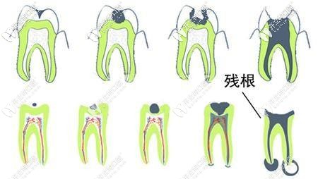 拿什么拯救你20幾年沒拔的牙齒殘根,不拔掉會怎么樣