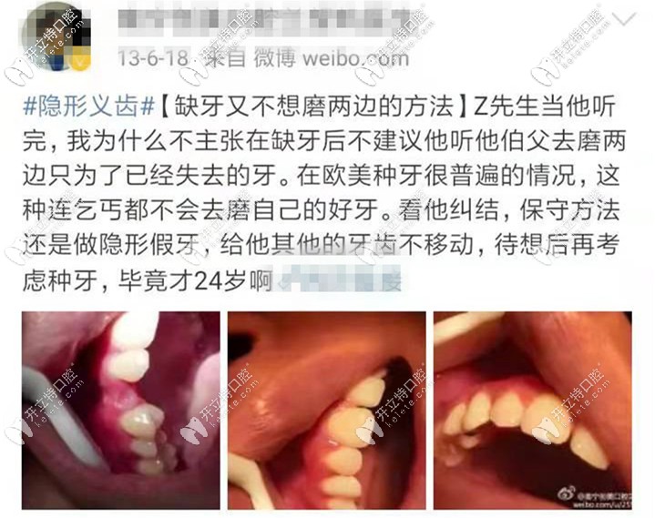 年紀輕輕缺牙醫(yī)生建議做隱形義齒