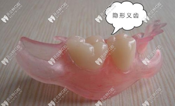 就想知道隱形義齒是否可以長期佩戴?包括晚上也不摘下來