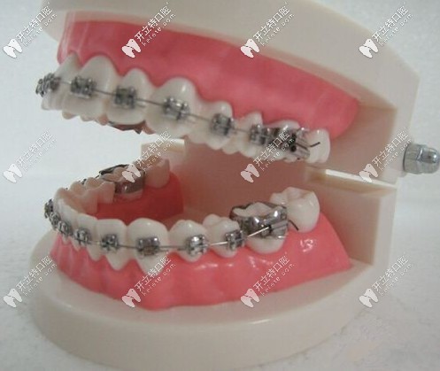 金屬牙齒矯正怎么樣