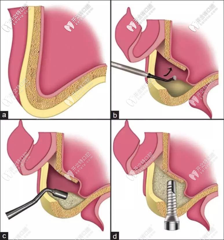 上頜竇外提升術(shù)