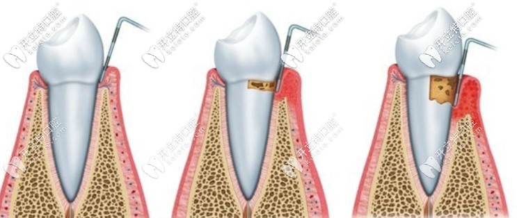 齦下刮治全口需要多少錢