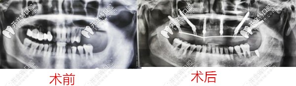 <!--<i data=20240703-sp></i>-->牙槽骨不足種植<span style=