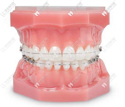 陶瓷半隱形牙齒矯正