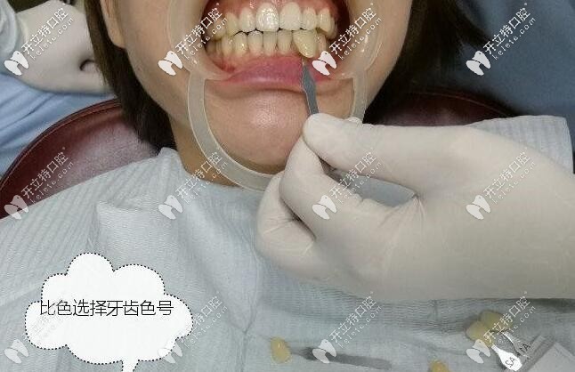 西安畫美團(tuán)圓口腔皓齒美白案例